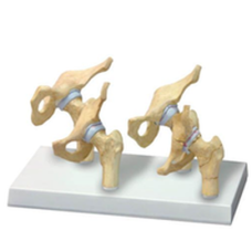 4-Stage Hip Osteoarthritis Anatomy Model