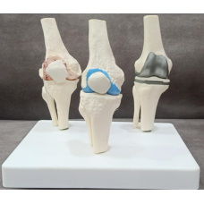 3-Stage Arthritis Knee Anatomy Model with Implant