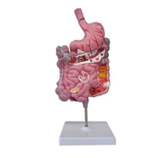 Diseased Digestive System Anatomy Model