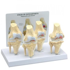 4-Stage Knee Arthritis Anatomy Model