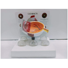 Cataract Eye Anatomy Model